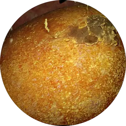 전립선 암 조기 발견