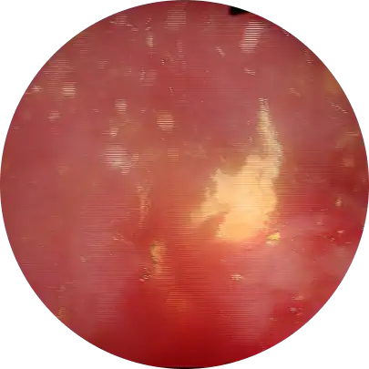 전립선 암 조기 발견