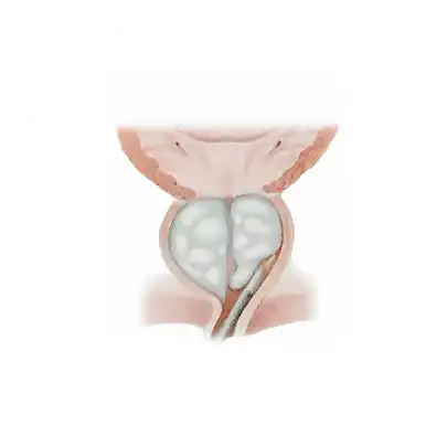 전립선 암 조기 발견