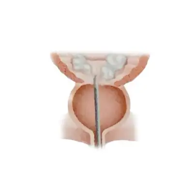 전립선 암 조기 발견