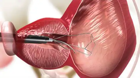 전립선 암 조기 발견