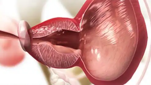 전립선 암 조기 발견