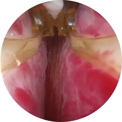 전립선 암 조기 발견