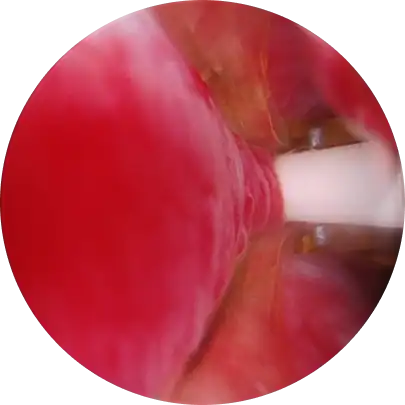 전립선 암 조기 발견