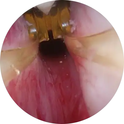 전립선 암 조기 발견