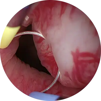 전립선 암 조기 발견