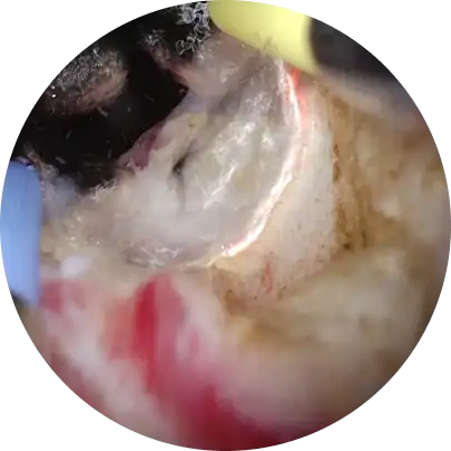 전립선 암 조기 발견