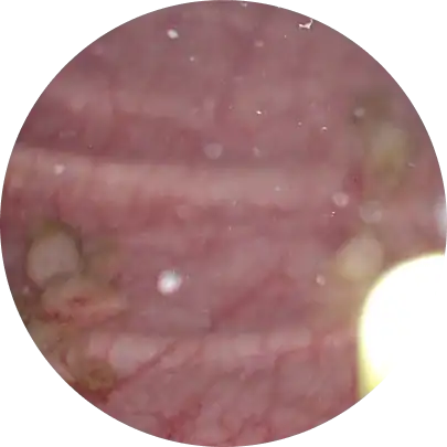 전립선 암 조기 발견