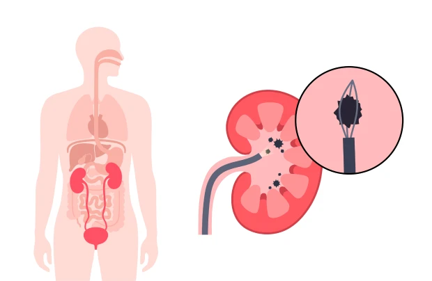 요로 폐색 치료를 위해 요관 스텐트를 삽입하는 과정을 보여주는 의료 일러스트