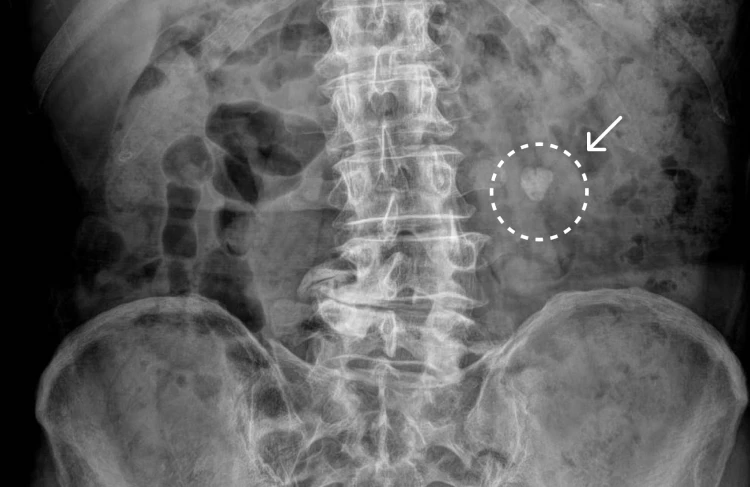 신장 부위에 요로결석이 나타난 엑스레이 이미지, 흰색 원과 화살표로 표시됨