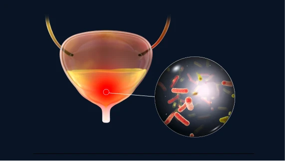 전립선 암 조기 발견