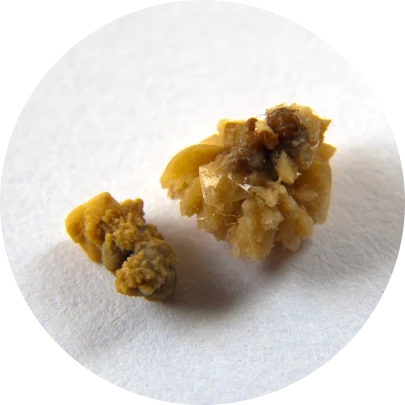 전립선 암 조기 발견