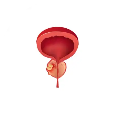 전립선 암 조기 발견