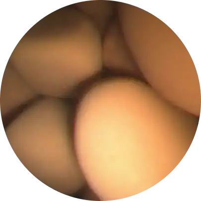 전립선 암 조기 발견