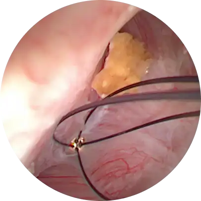 전립선 암 조기 발견